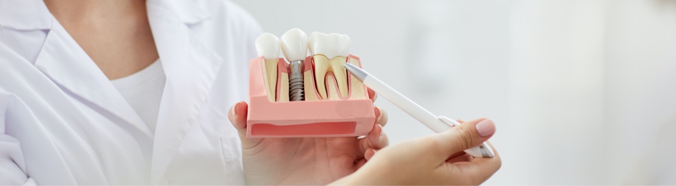 cobo-garrido-clinica-dental-madrid-implantologia